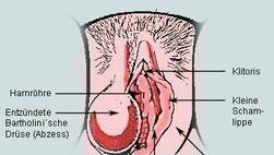 Bartholinitis: Entzündung im Bereich der Bartholinschen Drüse